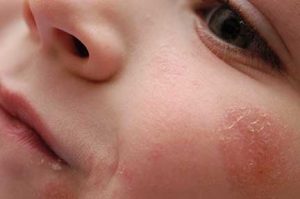 eczema home remedies