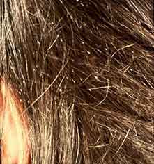 lice on hair